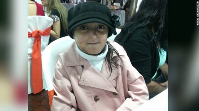 Jessica Ramirez morreu doença pele de borboleta epidermiólise bolhosa