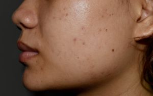 Espinhas e acnes: Tratamentos caseiros para acabar com o problema no rosto
