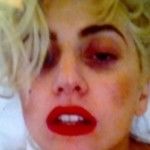 Lady Gaga posta foto com olho roxo