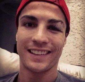 Cristiano Ronaldo posta foto de olho machucado e agradece as fãs pelas mensagens