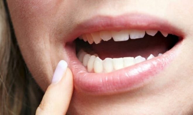 Confira algumas curiosidades sobre o dente siso