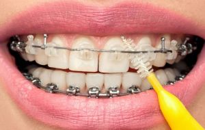Dicas e cuidados de higiene bucal para quem usa aparelho fixo