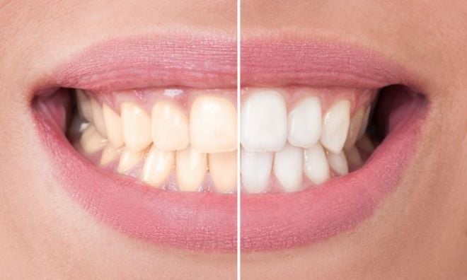 Clareamento dental: Confira alguns mitos sobre o tratamento