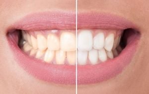 Clareamento dental: Confira alguns mitos sobre o tratamento