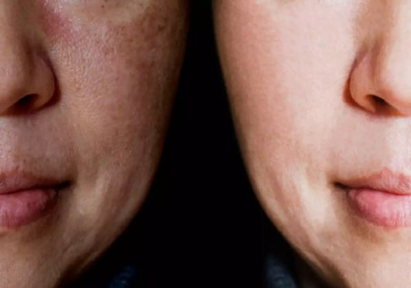 Melasma: Saiba o que é e confira tratamentos caseiros.