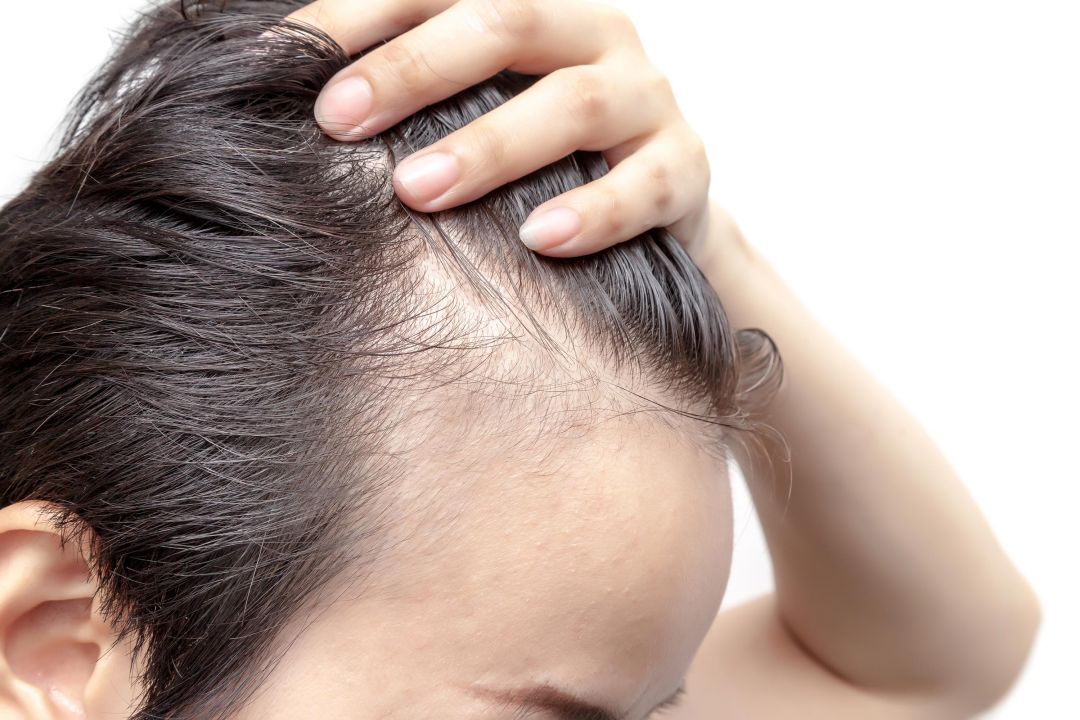 Calvície na adolescência: entenda as causas se saiba se pode ser revertida