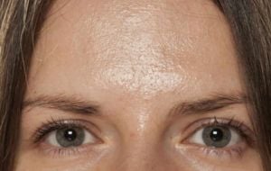 Oleosidade no rosto: 5 dicas práticas para diminuir e controlar o problema