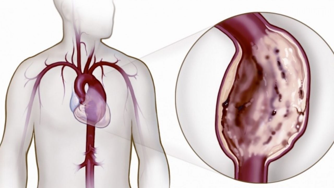 Aneurisma da aorta torácica: entenda o que é a doença que o Otaviano Costa descobriu