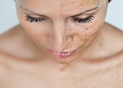 Algumas maneiras de se livrar das manchas do Sol