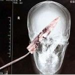 Chinês passa quatro anos com lâmina de faca na cabeça sem perceber