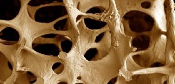 Osteoporose: endocrinologista desvenda mitos e verdades sobre a doença