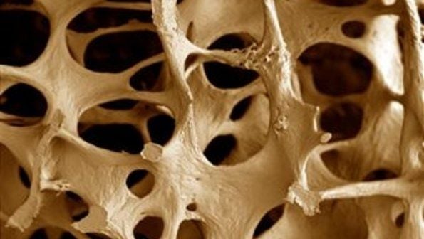 mitos-sobre-osteoporose