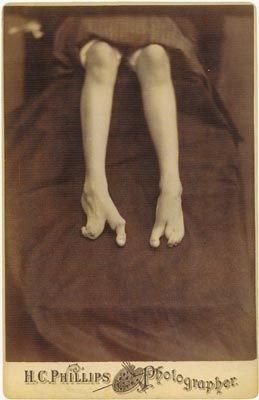 Deformidade do pé Deformidade do pé