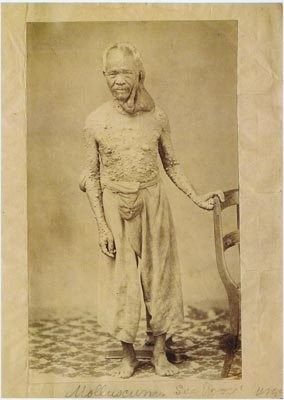 Neurofibromatose Neurofibromatose