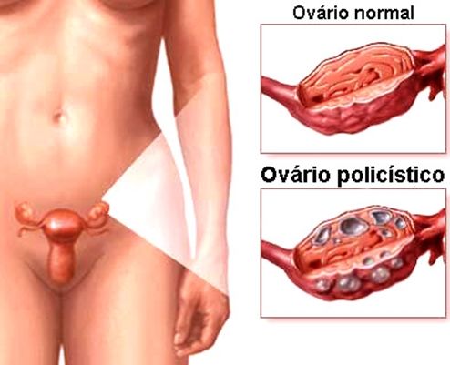 ovario-policistico