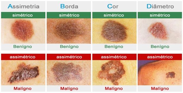 Qual tipo de mancha na pele e perigosa?