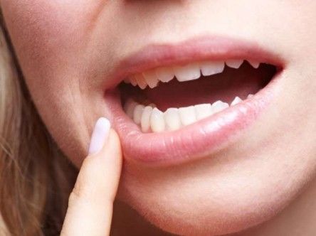 Dente do siso: Todos os mitos e verdades que você precisa conhecer sobre o assunto