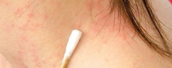 Psoríase: Fatos que você precisa conhecer sobre a doença