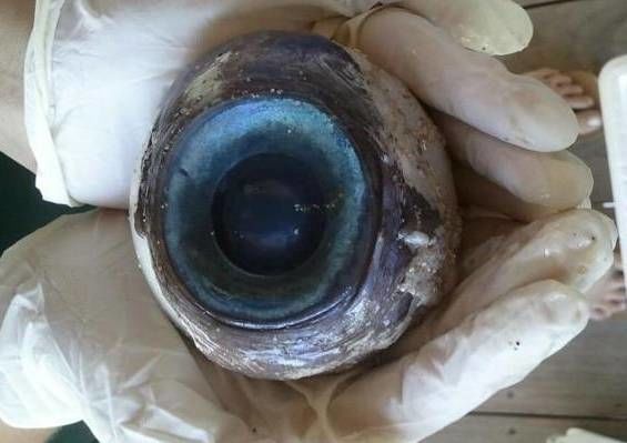 Globo ocular gigante